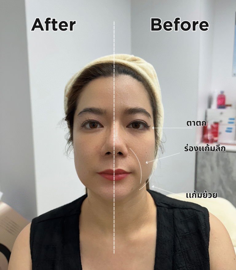 Split clinic photograph comparing two points in an individual facial treatment journey