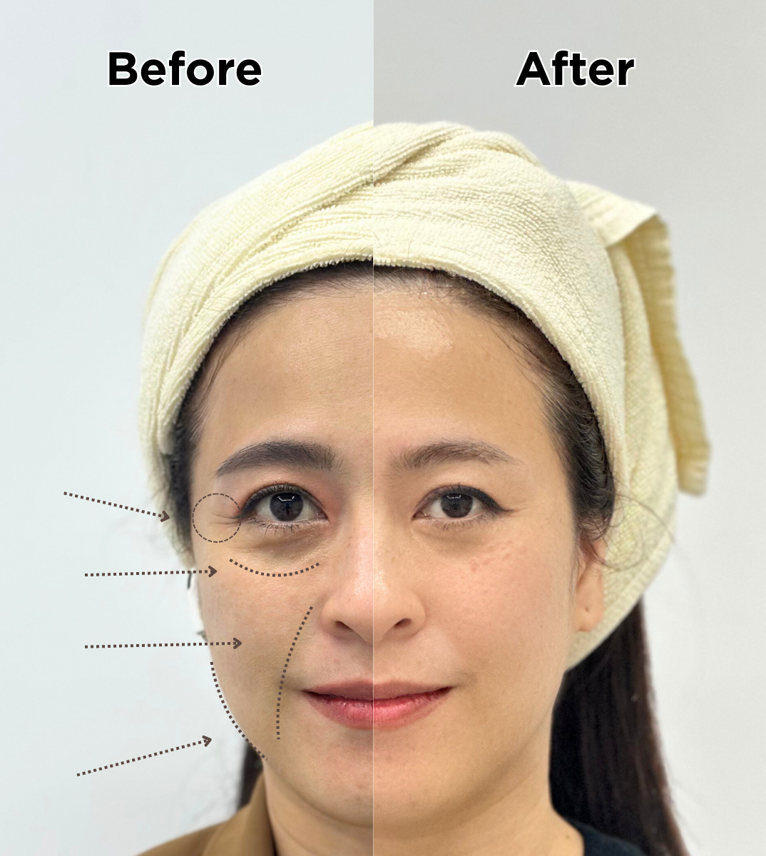 FTV Clinic non-surgical lifting treatment