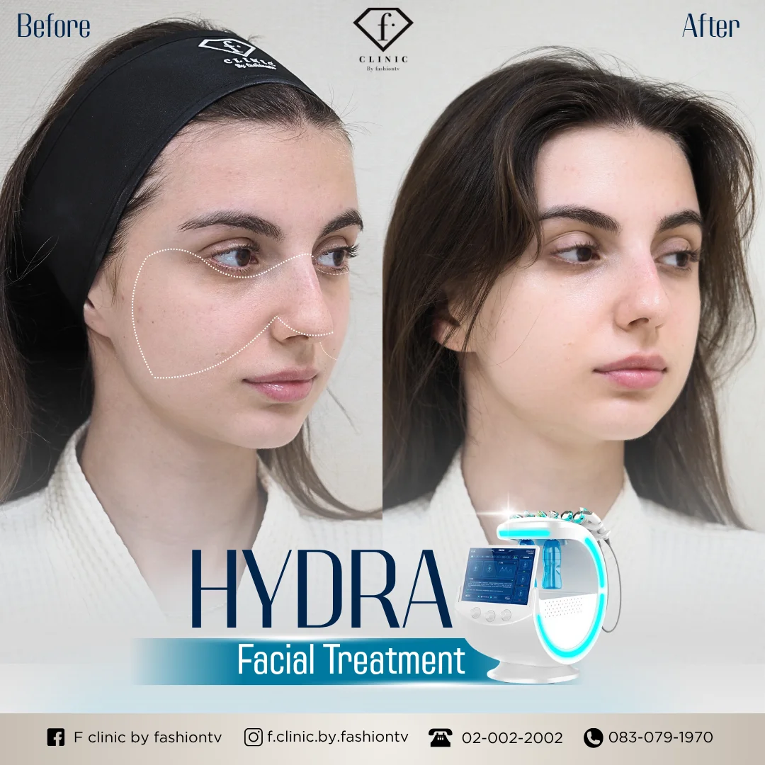 Second example before and after HydraFacial images published by FTV Clinic
