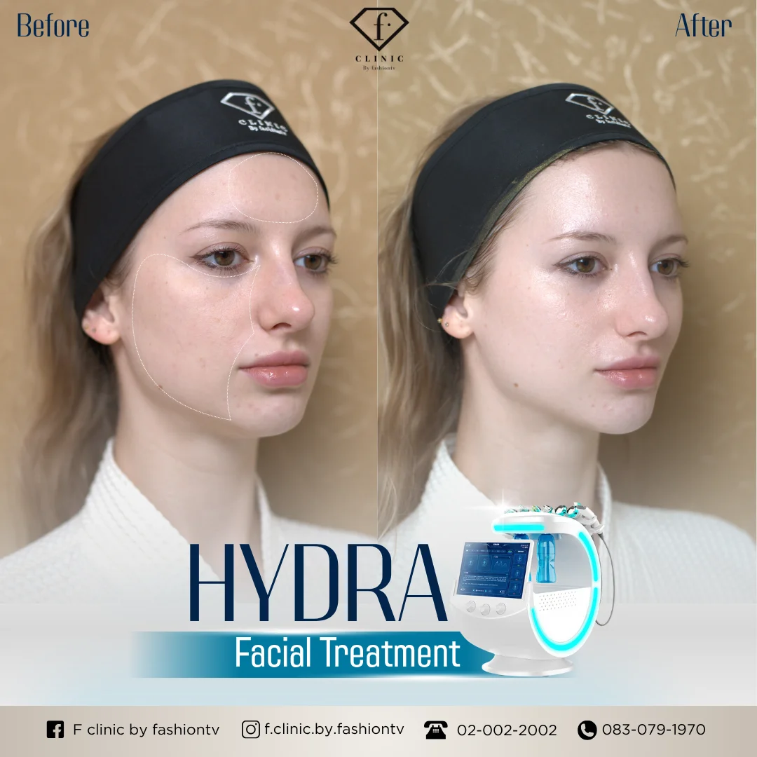 Example before and after HydraFacial images published by FTV Clinic